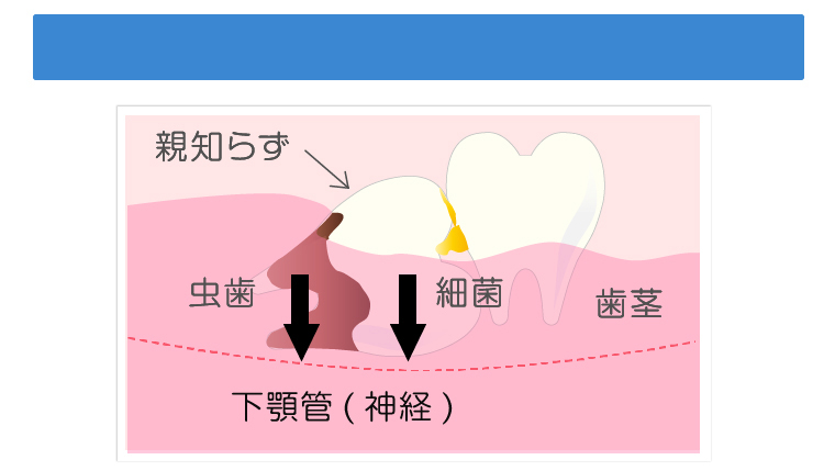 親知らずの最適な治療方法をご紹介 大阪羽曳野市の加藤歯科